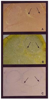 The Unifying Hypothesis of Alzheimer’s Disease: Heparan Sulfate Proteoglycans/Glycosaminoglycans Are Key as First Hypothesized Over 30 Years Ago